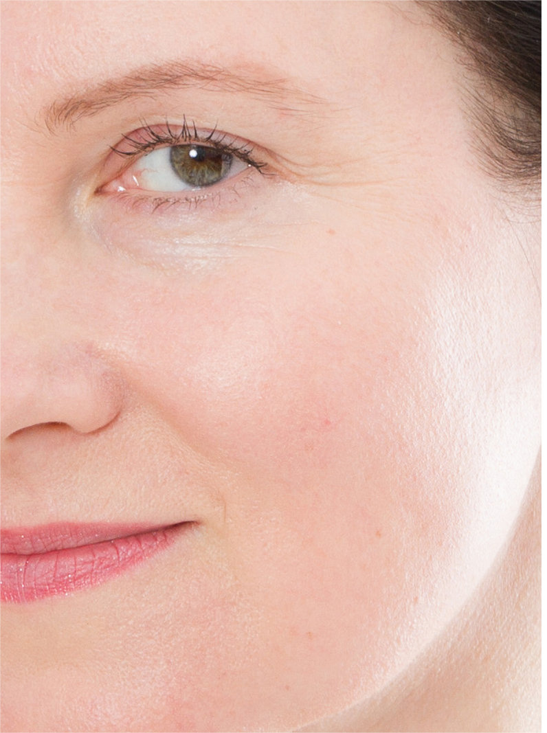 0 dermal filler wholesale